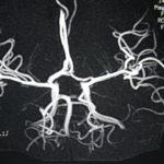 Imagen de Angioresonancia cerebral.