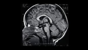 Corte sagital, Resonancia Magnética Cerebral Corte sagital, Resonancia Magnética Cerebral